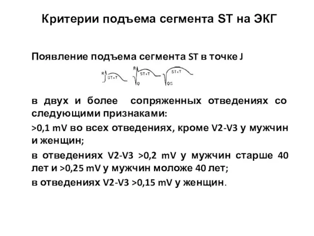 Критерии подъема сегмента ST на ЭКГ Появление подъема сегмента ST