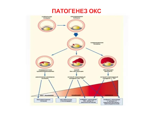 ПАТОГЕНЕЗ ОКС