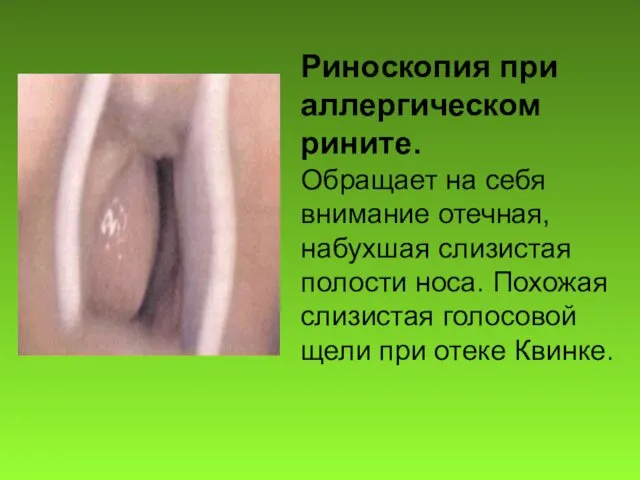 Риноскопия при аллергическом рините. Обращает на себя внимание отечная, набухшая слизистая полости носа.