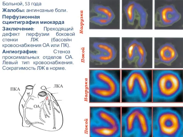 Больной, 53 года Жалобы: ангинозные боли. Перфузионная сцинтиграфия миокарда Заключение:
