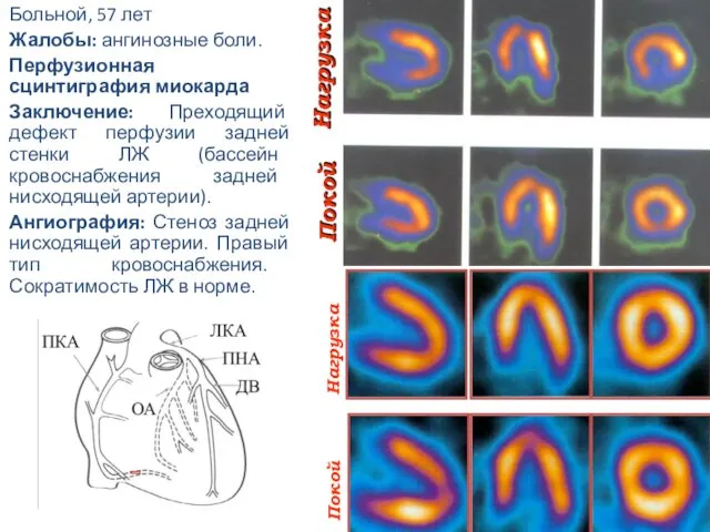 Больной, 57 лет Жалобы: ангинозные боли. Перфузионная сцинтиграфия миокарда Заключение: