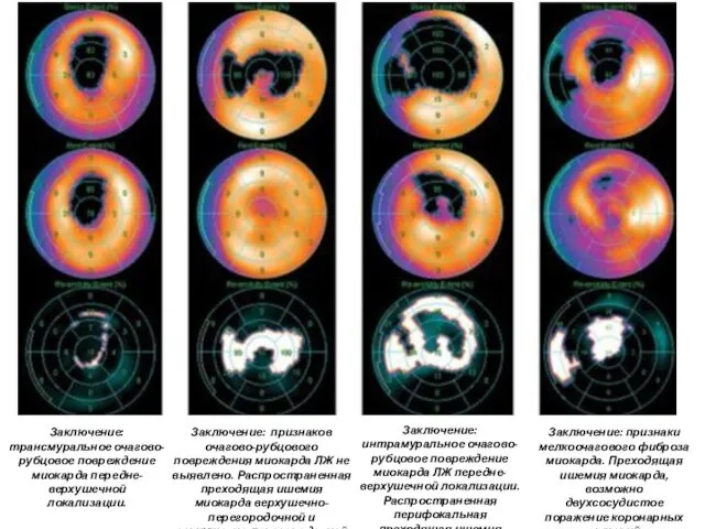 Заключение: трансмуральное очагово-рубцовое повреждение миокарда передне-верхушечной локализации. Заключение: признаков очагово-рубцового