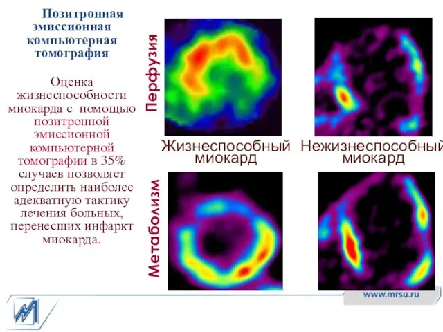 Позитронная эмиссионная компьютерная томография Оценка жизнеспособности миокарда с помощью позитронной