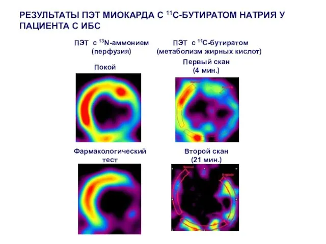 ПЭТ с 13N-аммонием (перфузия) Покой Фармакологический тест ПЭТ с 11С-бутиратом