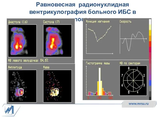 Равновесная радионуклидная вентрикулография больного ИБС в покое