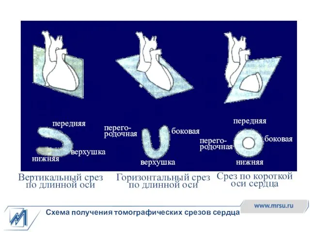 Схема получения томографических срезов сердца Вертикальный срез по длинной оси