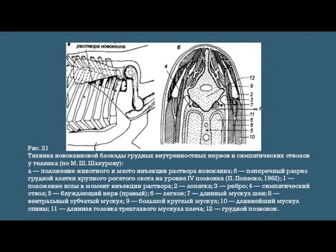 Рис. 21 Техника новокаиновой блокады грудных внутренностных нервов и симпатических