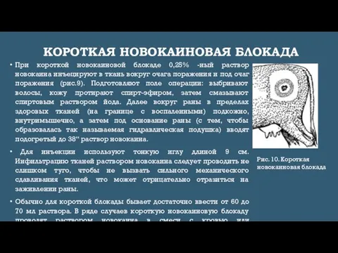 КОРОТКАЯ НОВОКАИНОВАЯ БЛОКАДА При короткой новокаиновой блокаде 0,25% -ный раствор