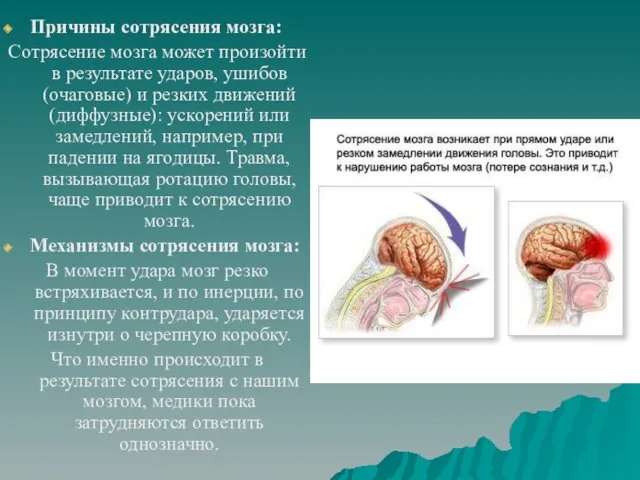 Причины сотрясения мозга: Сотрясение мозга может произойти в результате ударов, ушибов (очаговые) и