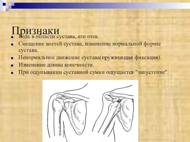 Признаки Боль в области сустава, его отек. Смещение костей сустава, изменение нормальной формы