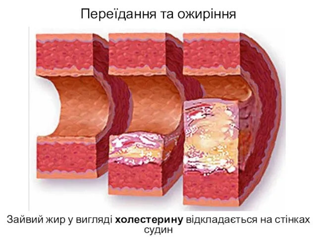 Переїдання та ожиріння Зайвий жир у вигляді холестерину відкладається на стінках судин