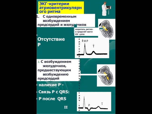 ЭКГ-критерии атриовентрикулярного ритма 2. С возбуждением желудочков, предшествующим возбуждению предсердий