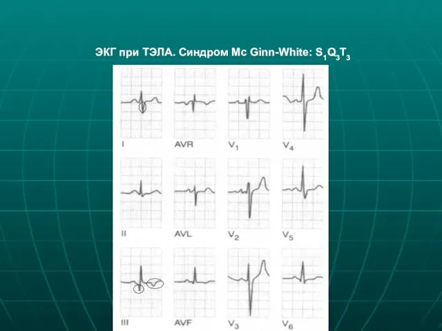 ЭКГ при ТЭЛА. Синдром Mc Ginn-White: S1Q3T3