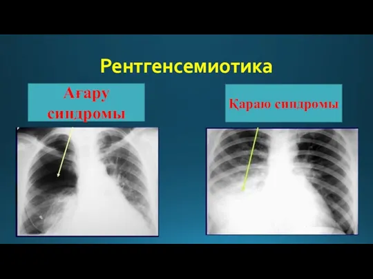 Рентгенсемиотика Ағару синдромы Қараю синдромы