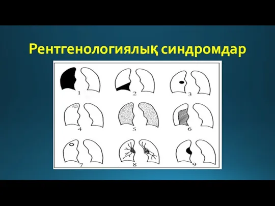 Рентгенологиялық синдромдар