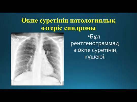 Өкпе суретінің патологиялық өзгеріс синдромы Бұл рентгенограммада өкпе суретінің күшеюі.