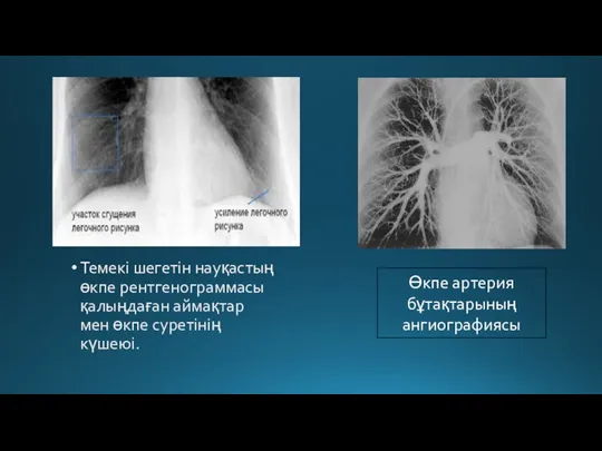 Темекі шегетін науқастың өкпе рентгенограммасы қалыңдаған аймақтар мен өкпе суретінің күшеюі. Өкпе артерия бұтақтарының ангиографиясы