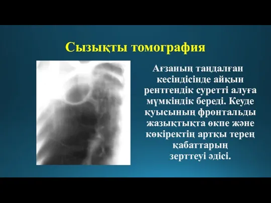 Сызықты томография Ағзаның таңдалған кесіндісінде айқын рентгендік суретті алуға мүмкіндік
