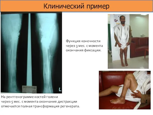 Клинический пример На рентгенограмме костей голени через 5 мес. с момента окончания дистракции