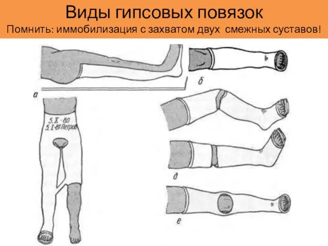 Виды гипсовых повязок Помнить: иммобилизация с захватом двух смежных суставов!