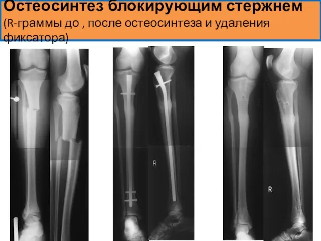 Остеосинтез блокирующим стержнем (R-граммы до , после остеосинтеза и удаления фиксатора)