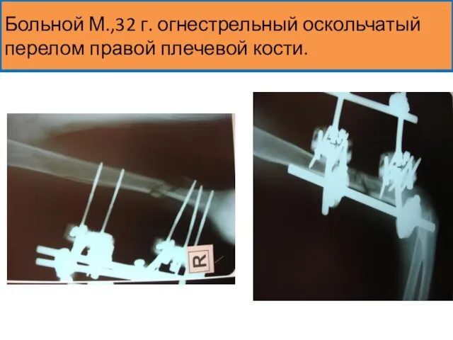 Больной М.,32 г. огнестрельный оскольчатый перелом правой плечевой кости.