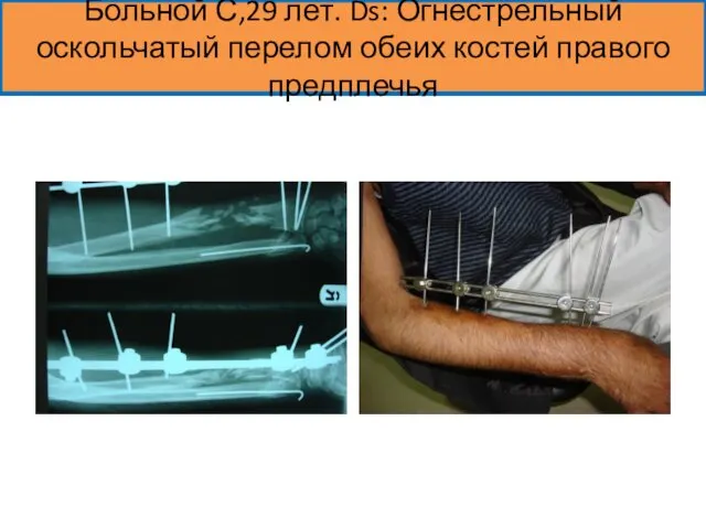 Больной С,29 лет. Ds: Огнестрельный оскольчатый перелом обеих костей правого предплечья