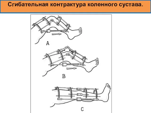 Сгибательная контрактура коленного сустава.