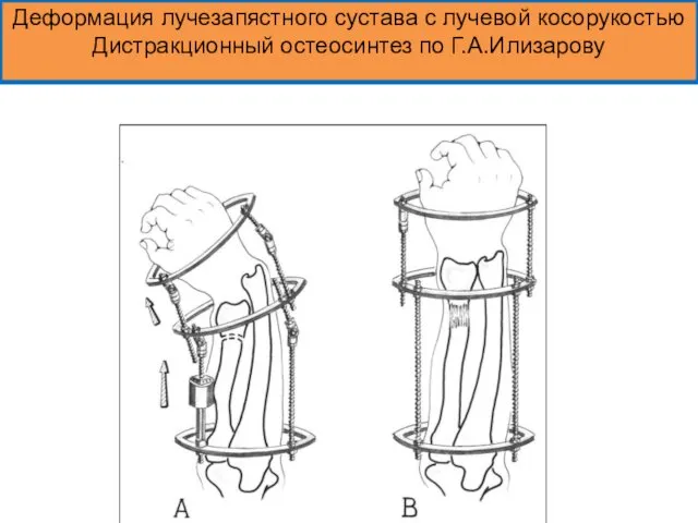 Деформация лучезапястного сустава с лучевой косорукостью Дистракционный остеосинтез по Г.А.Илизарову