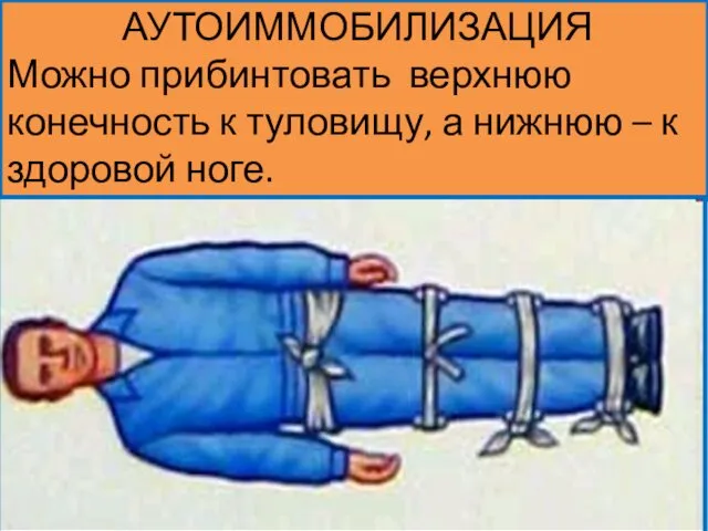 АУТОИММОБИЛИЗАЦИЯ Можно прибинтовать верхнюю конечность к туловищу, а нижнюю – к здоровой ноге.