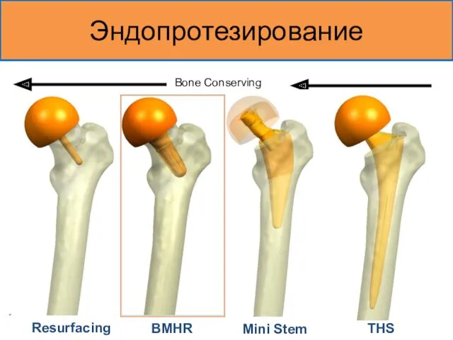Эндопротезирование Resurfacing Bone Conserving Mini Stem THS BMHR
