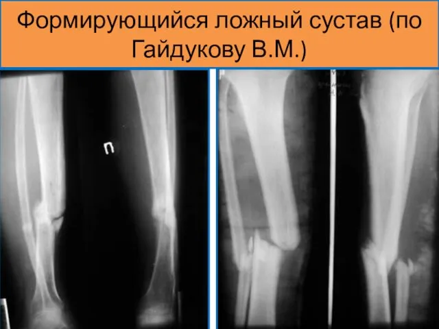 Формирующийся ложный сустав (по Гайдукову В.М.)