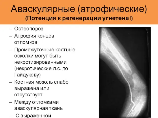 Аваскулярные (атрофические) (Потенция к регенерации угнетена!) Остеопороз Атрофия концов отломков Промежуточные костные осколки