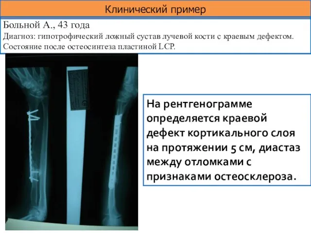 Клинический пример Больной А., 43 года Диагноз: гипотрофический ложный сустав лучевой кости с
