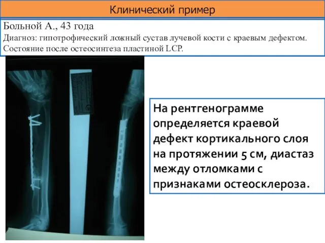 Клинический пример Больной А., 43 года Диагноз: гипотрофический ложный сустав