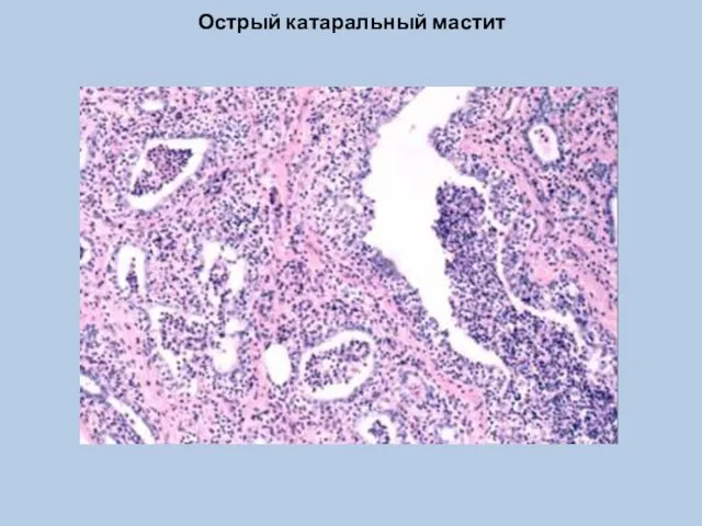 Острый катаральный мастит