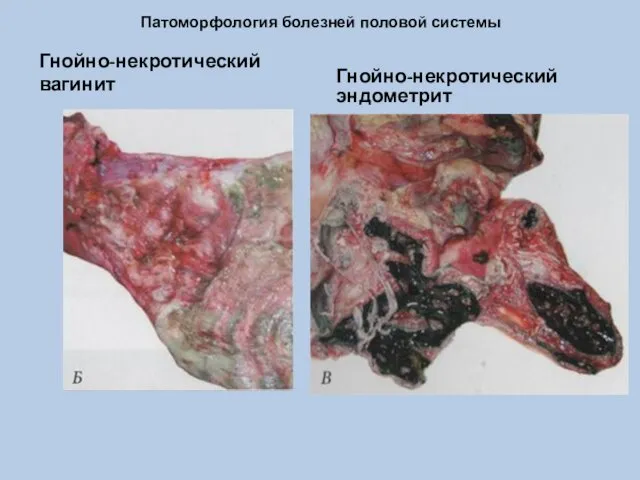 Патоморфология болезней половой системы Гнойно-некротический вагинит Гнойно-некротический эндометрит