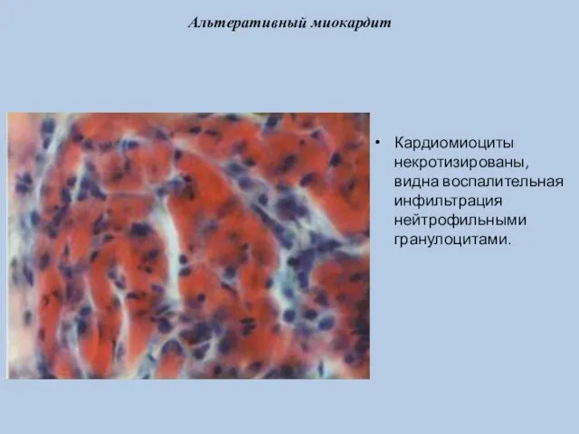 Альтеративный миокардит Кардиомиоциты некротизированы, видна воспалительная инфильтрация нейтрофильными гранулоцитами.