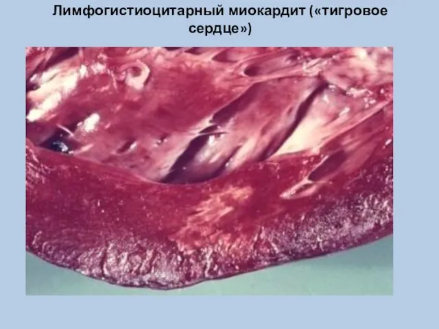 Лимфогистиоцитарный миокардит («тигровое сердце»)