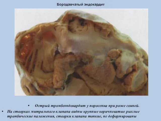 Бородавчатый эндокардит Острый тромбоэндокардит у поросенка при роже свиней. На