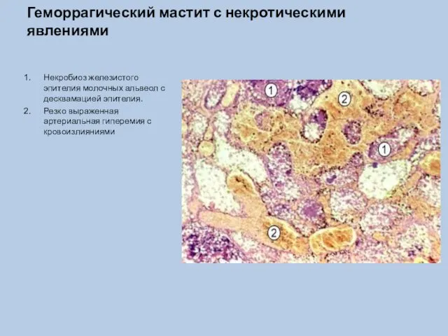 Геморрагический мастит с некротическими явлениями Некробиоз железистого эпителия молочных альвеол