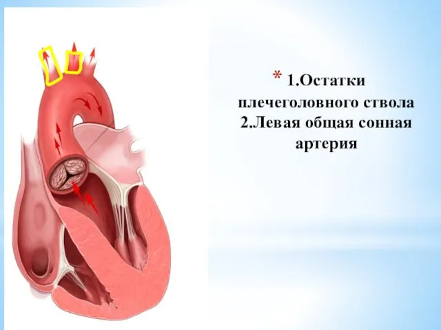 1.Остатки плечеголовного ствола 2.Левая общая сонная артерия