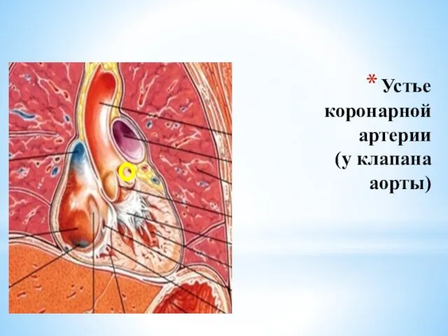 Устье коронарной артерии (у клапана аорты)