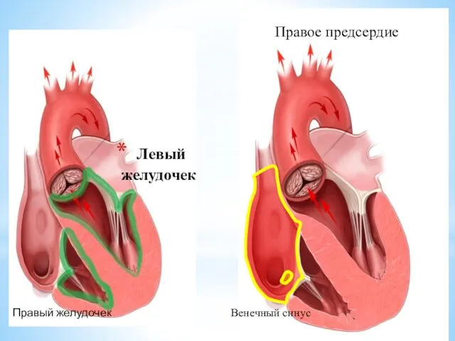 Левый желудочек Правое предсердие Венечный синус Правый желудочек