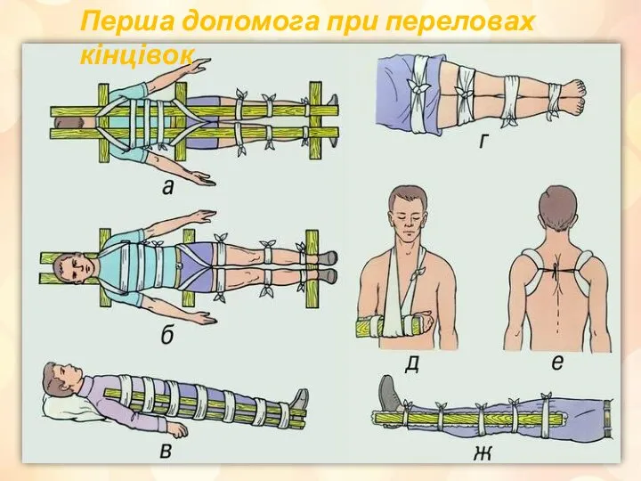 Перша допомога при переловах кінцівок