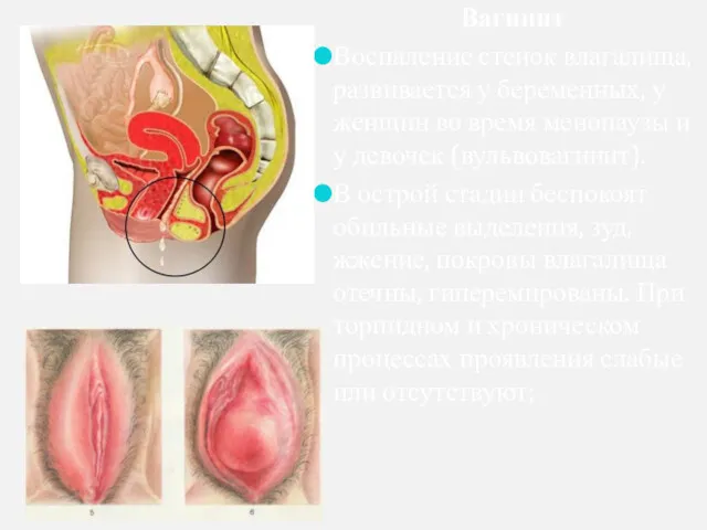 Вагинит Воспаление стенок влагалища, развивается у беременных, у женщин во время менопаузы и