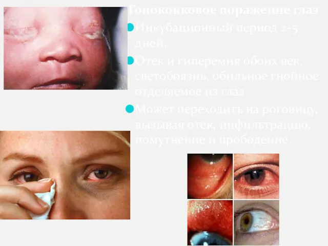 Гонококковое поражение глаз Инкубационный период 2-5 дней. Отек и гиперемия
