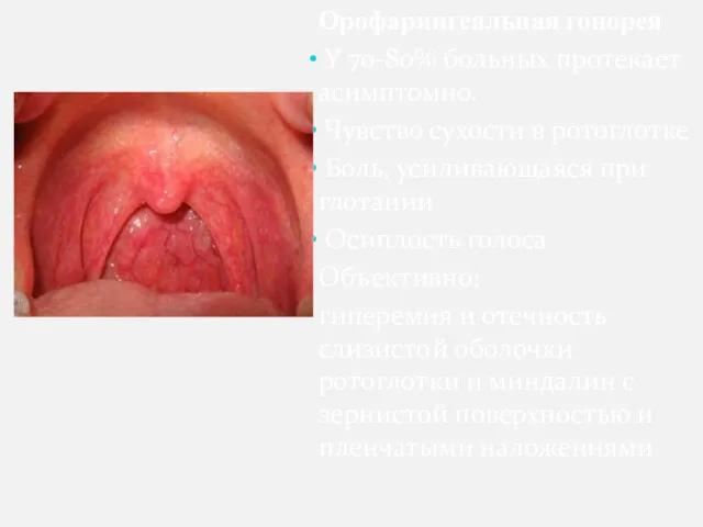 Орофарингеальная гонорея У 70-80% больных протекает асимптомно. Чувство сухости в ротоглотке Боль, усиливающаяся