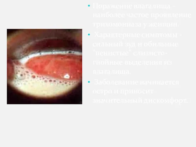 Поражение влагалища - наиболее частое проявление трихомониаза у женщин. Характерные симптомы - сильный