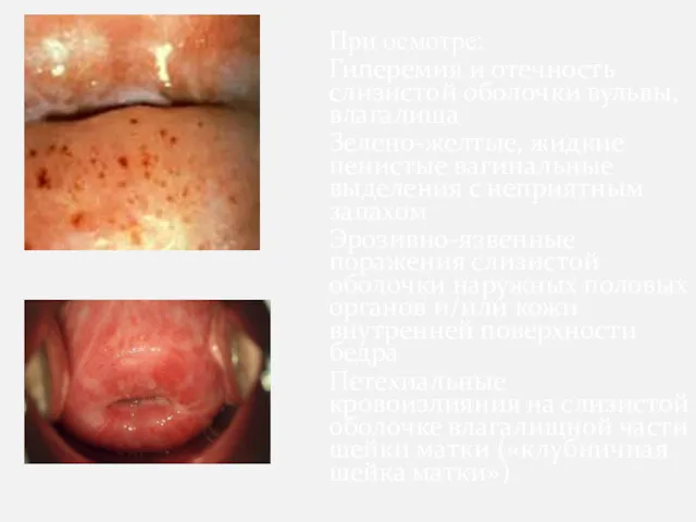 При осмотре: Гиперемия и отечность слизистой оболочки вульвы, влагалища Зелено-желтые,
